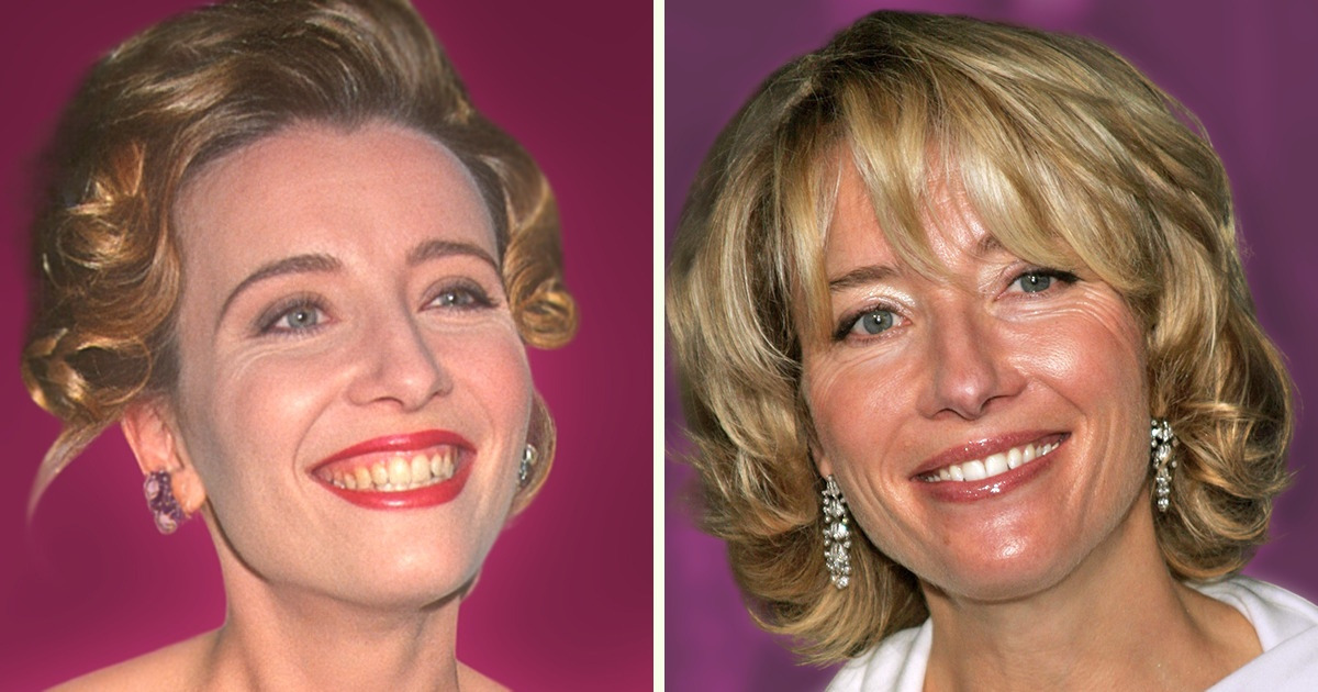 19 Celebridades que mudaram os dentes e deram novo brilho ao sorriso