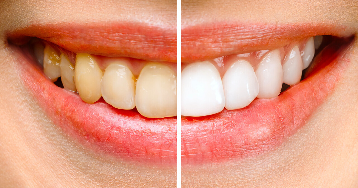 Pare de molhar a escova de dentes se quiser dentes mais brancos