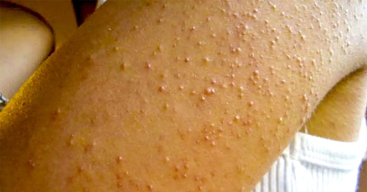 Como evitar problemas de pele apenas mudando os hábitos alimentares