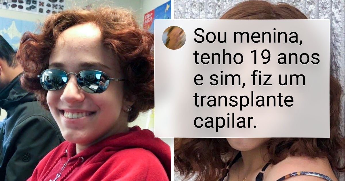 14 Pessoas que tiveram de lidar com a perda de cabelo e enfrentaram a situação