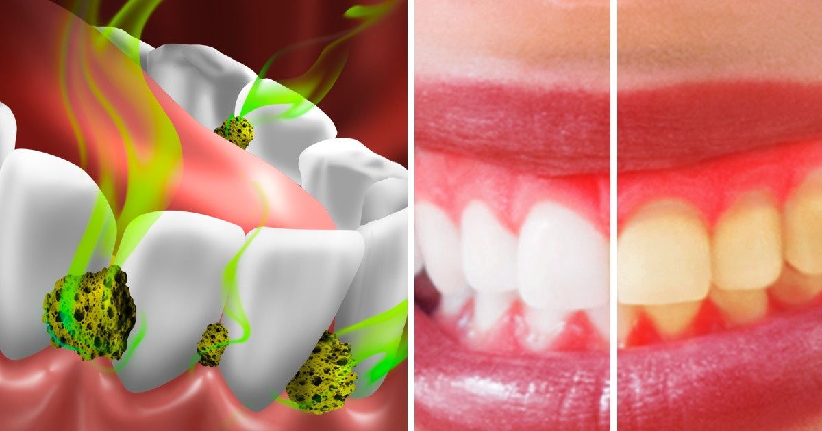 7 Formas de matar as bactérias que causam o mau hálito 7 Formas de matar as bactérias que causam o mau hálito