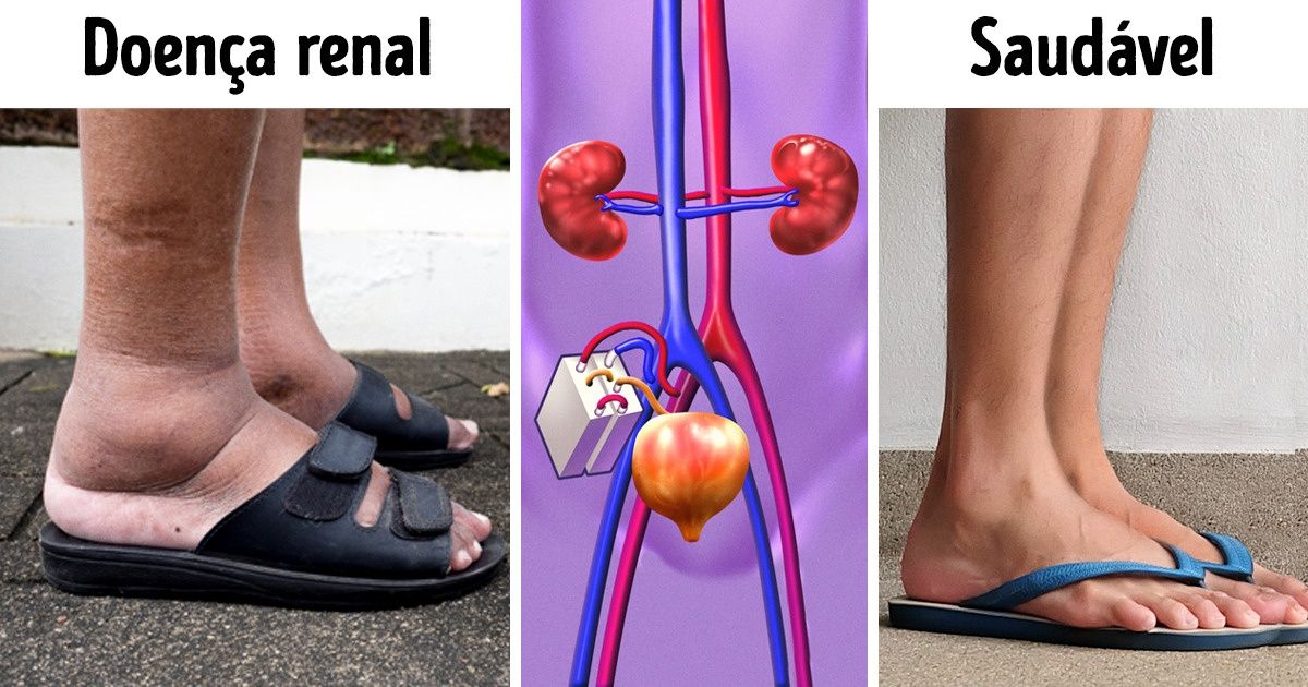 Cientistas desenvolvem um rim biônico após 15 anos de pesquisa