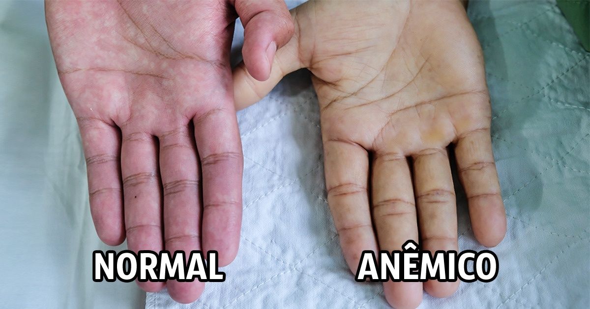 7 Sinais De Anemia E 7 Tratamentos Para Esse Tipo De Problema Incrível