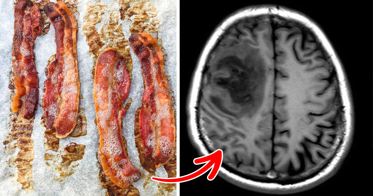 Homem descobre larvas de parasita no cérebro após anos de consumo de bacon malpassado