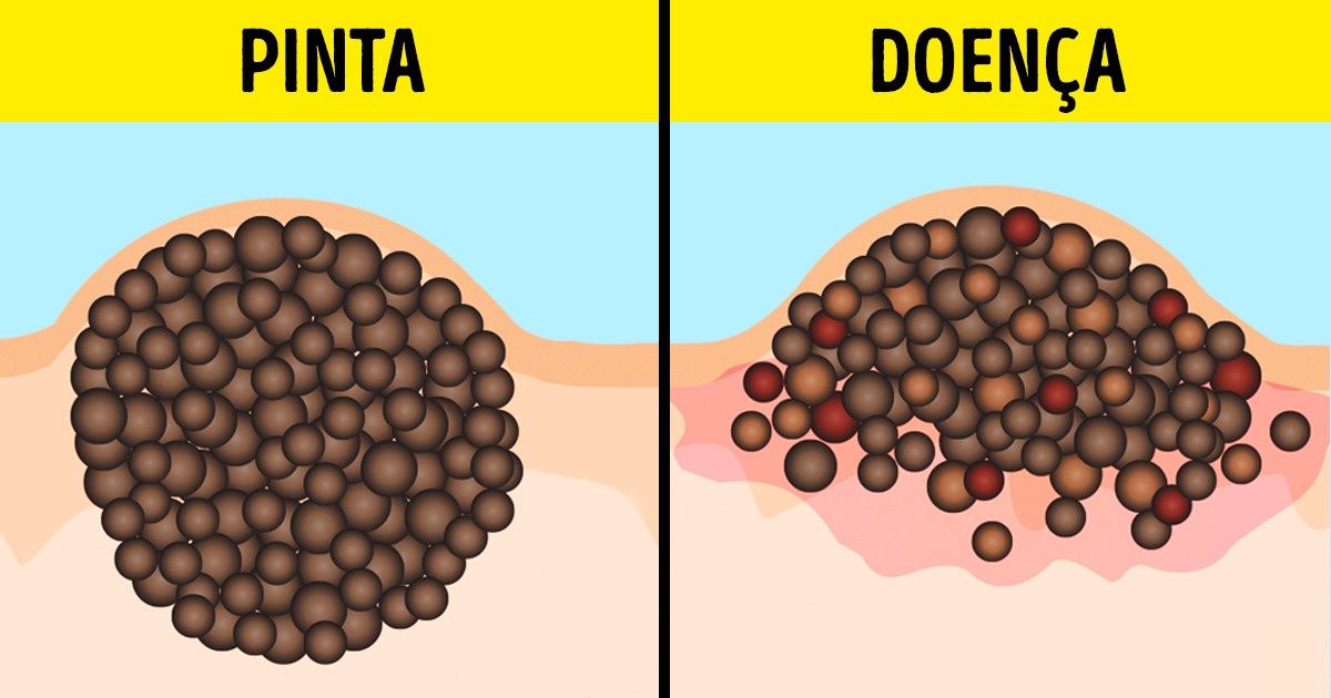 9 Mitos perigosos sobre bronzeado e pintas que até mesmo alguns médicos acreditam