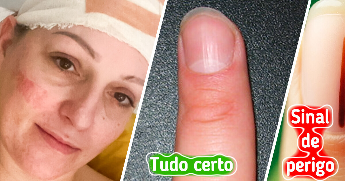 Um pequeno sinal na unha revelou que o câncer terminal já atingia seu cérebro