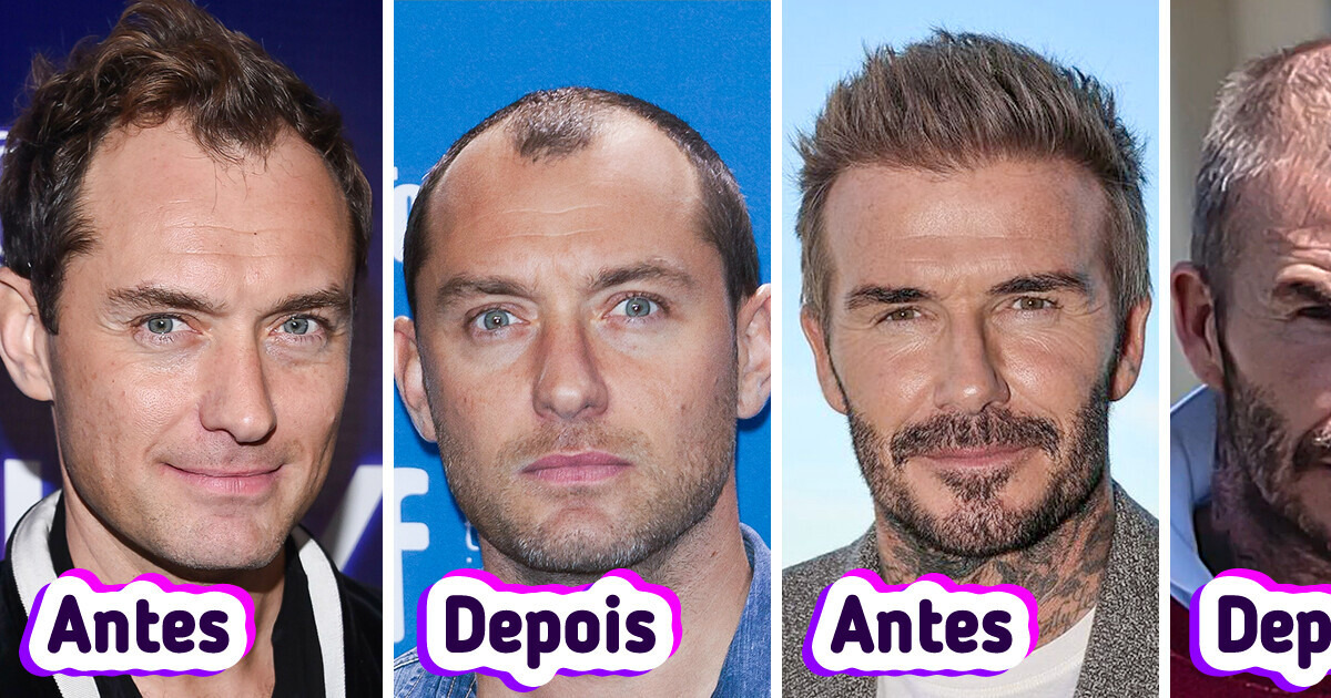 12 Famosos que nunca admitiram ter feito implante, mas o cabelo apareceu magicamente