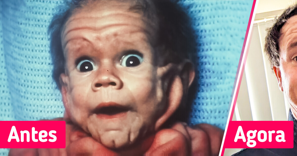 Um bebê nasceu com uma doença de pele rara que confundiu os médicos por 20 anos e superou enormes chances de viver Um bebê nasceu com uma doença de pele rara que confundiu os médicos por 20 anos e superou enormes chances de viver