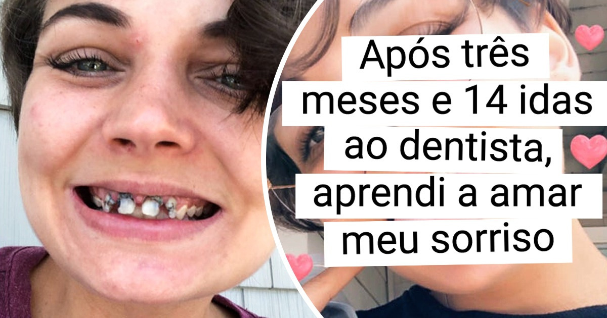 15+ Pessoas que decidiram ir ao dentista e conseguiram um sorriso de orelha a orelha