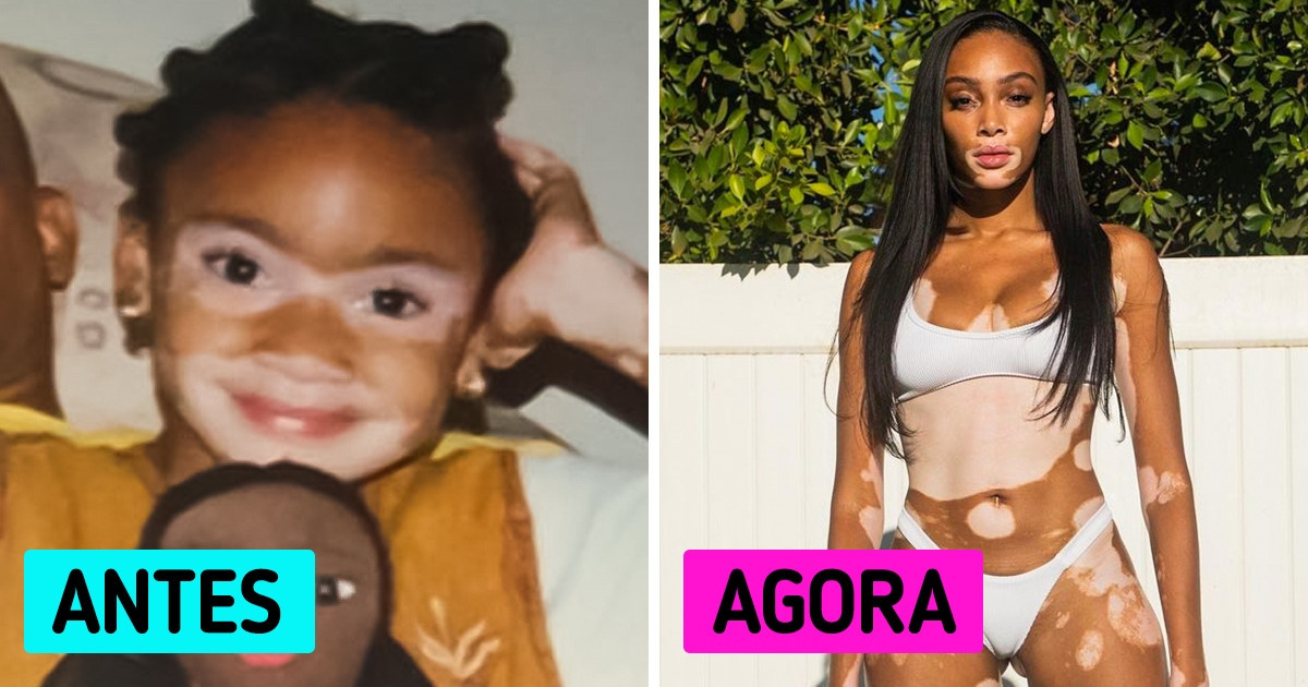 Winnie Harlow: a modelo que superou o vitiligo e conquistou o mundo com sua beleza única