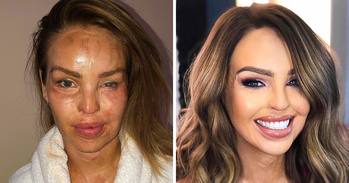 Katie Piper sobreviveu a um ataque com ácido de seu ex-namorado e ressurgiu das cinzas como uma fênix