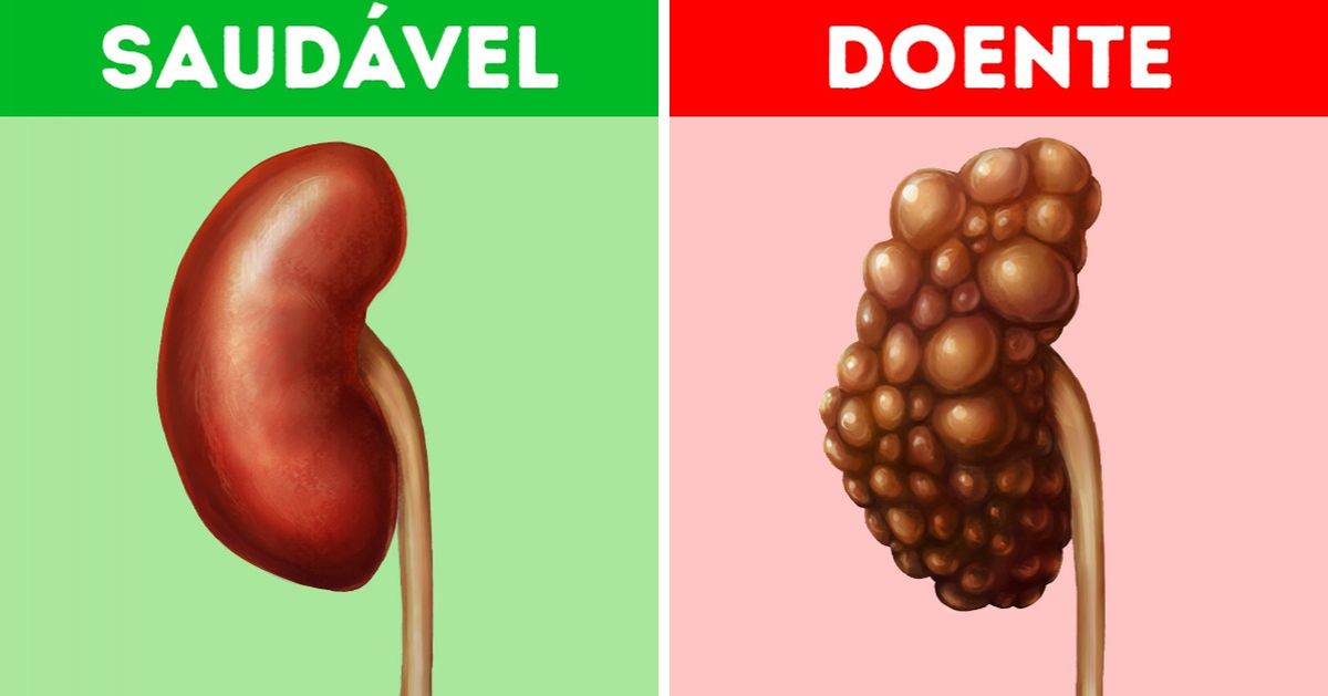 10 Hábitos comuns que podem afetar gravemente seus rins 10 Hábitos comuns que podem afetar gravemente seus rins