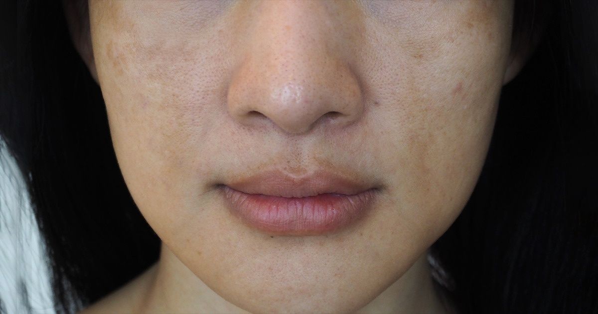 10 Sinais precoces de que seu corpo está ficando sem vitamina C