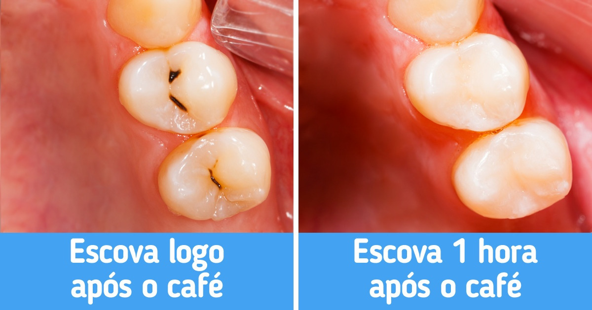 7 Dicas para deixar seus dentes brancos e saudáveis 7 Dicas para deixar seus dentes brancos e saudáveis