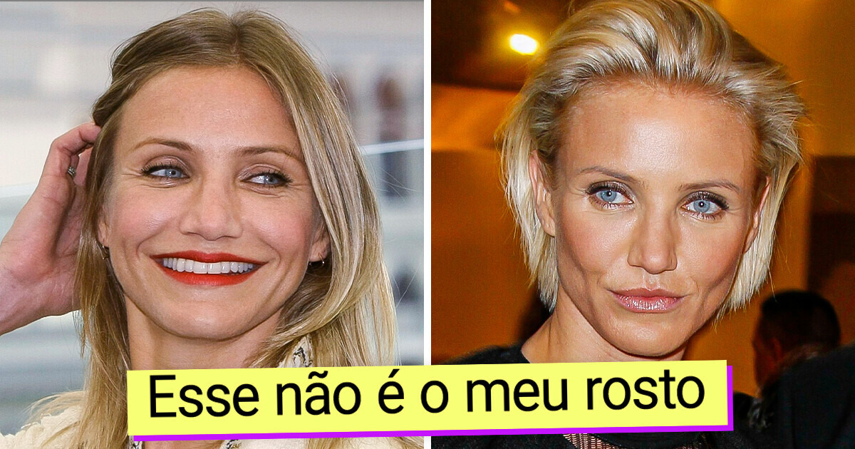 12 Celebridades que se arrependeram de suas cirurgias plásticas 12 Celebridades que se arrependeram de suas cirurgias plásticas