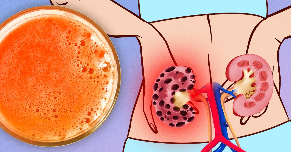 7 Alimentos populares que podem prejudicar seus rins