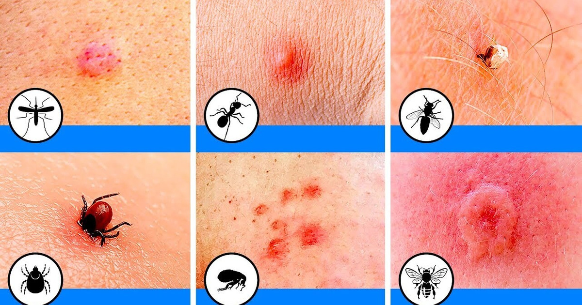10 Picadas de insetos que você deve ser capaz de identificar