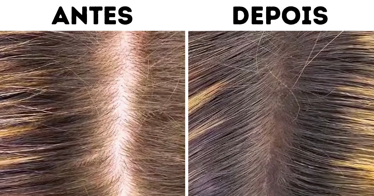 10 Formas incríveis de prevenir a queda de cabelo usando ingredientes naturais 10 Formas incríveis de prevenir a queda de cabelo usando ingredientes naturais