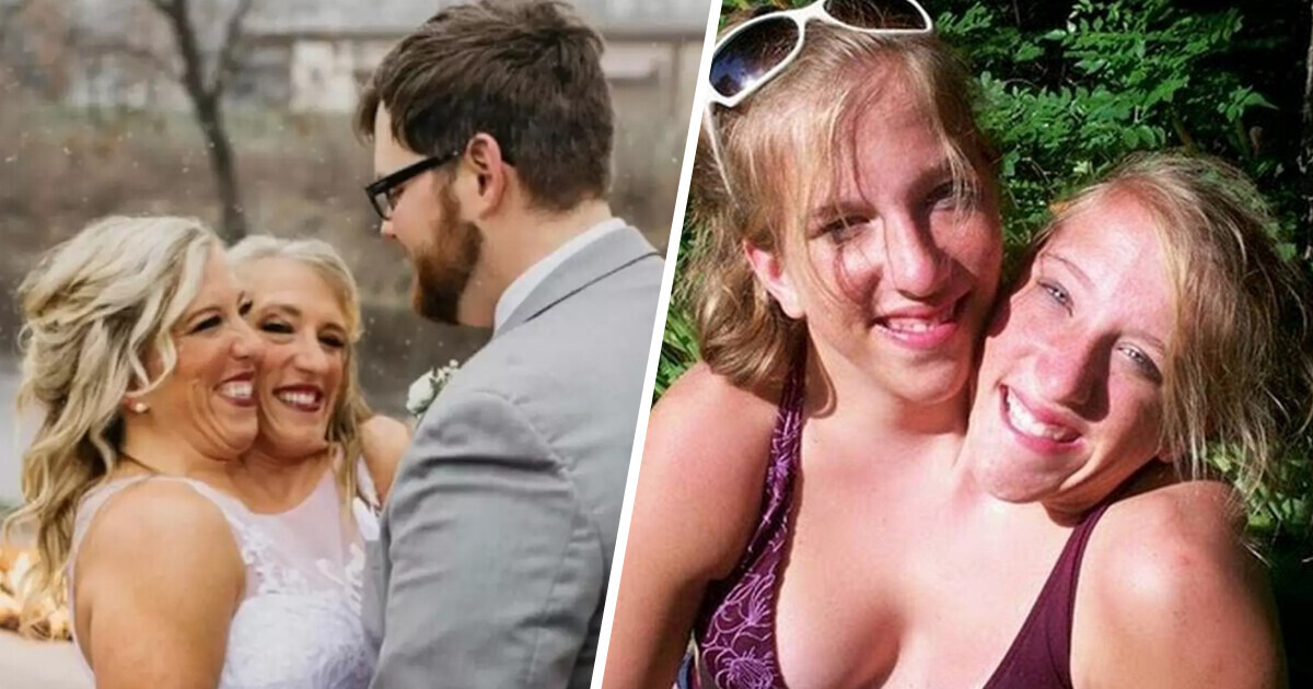 Gêmeas siamesas se casam e respondem à pergunta que todos estão se fazendo Gêmeas siamesas se casam e respondem à pergunta que todos estão se fazendo