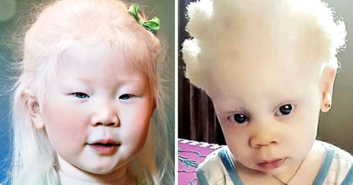 Imagens de pessoas albinas em diferentes partes do mundo