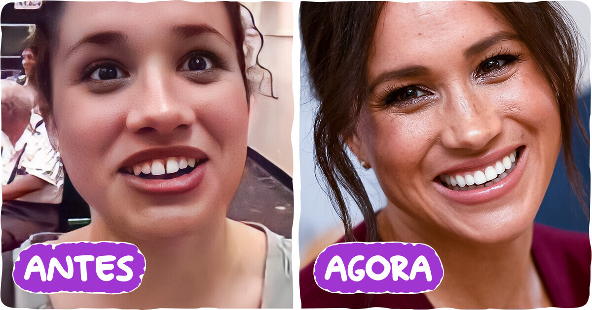 10+ Famosos que investiram pesado para conquistar um sorriso de capa de revista
