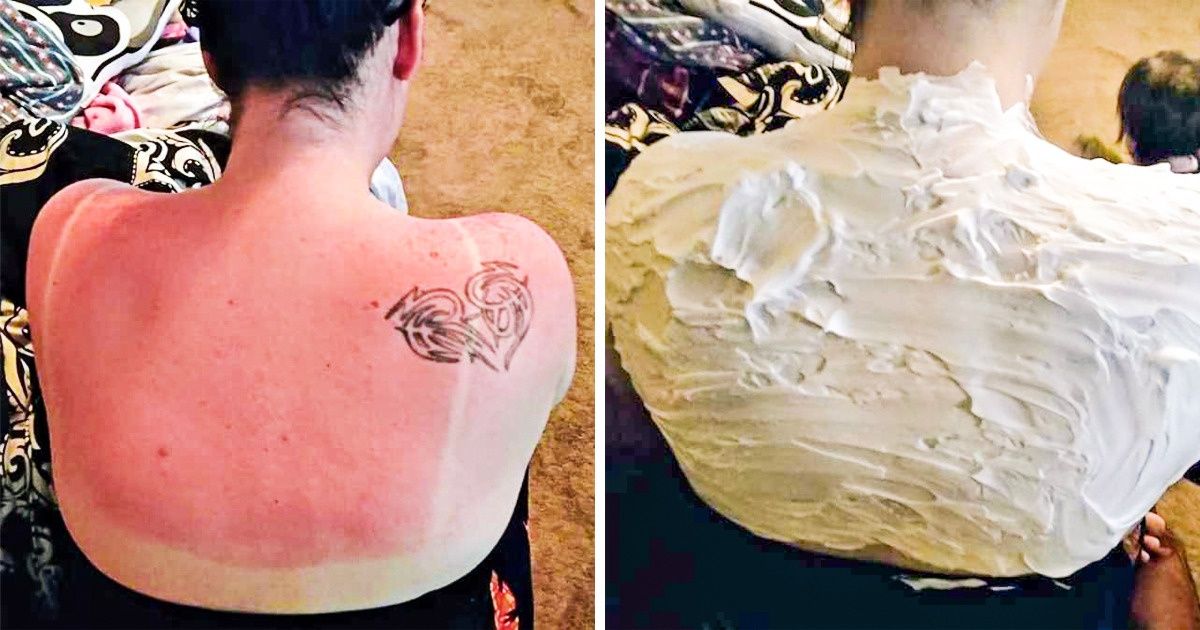 8 Maneiras naturais de tratar queimaduras de sol