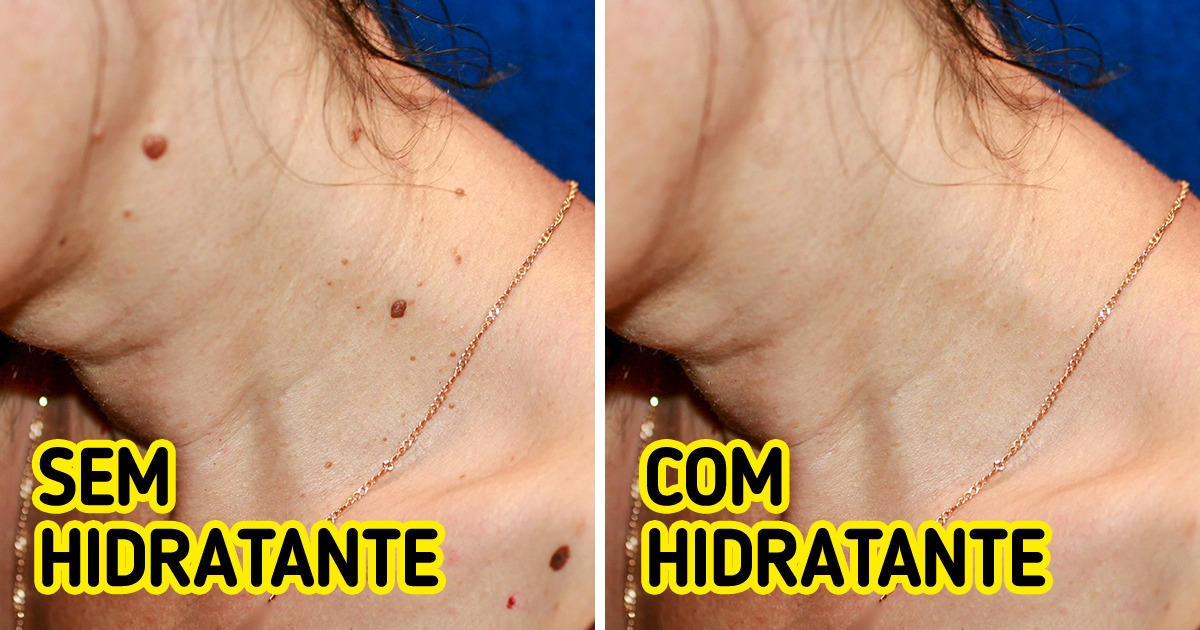 6 Maneiras para evitar e dar adeus às incômodas verrugas 6 Maneiras para evitar e dar adeus às incômodas verrugas