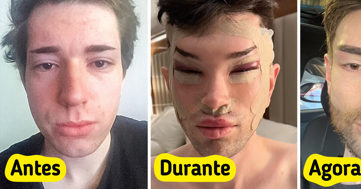 Homem mostra os resultados de suas cirurgias plásticas e choca as pessoas Homem mostra os resultados de suas cirurgias plásticas e choca as pessoas