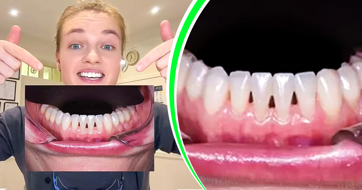 O que são os “triângulos pretos” que surgem entre os dentes e como lidar com eles O que são os “triângulos pretos” que surgem entre os dentes e como lidar com eles