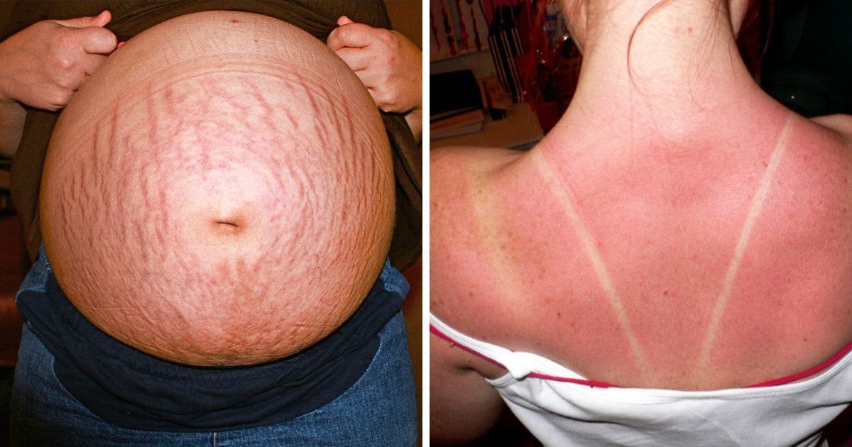 18 Maneiras de usar hamamélis que você nunca pensou