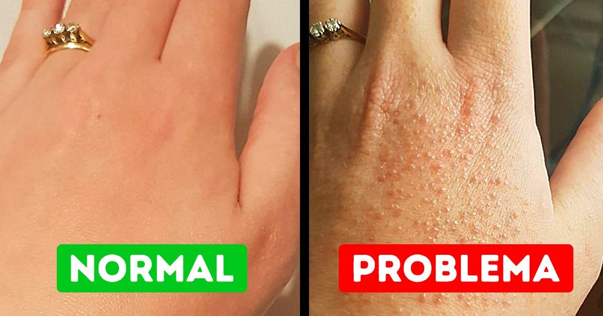 15 Coisas cotidianas a que você pode ser alérgico e nem saber 15 Coisas cotidianas a que você pode ser alérgico e nem saber