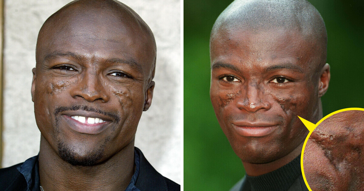Seal fala sobre as origens das cicatrizes "traumáticas" em seu rosto Seal fala sobre as origens das cicatrizes "traumáticas" em seu rosto
