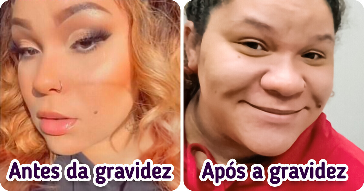 Duas pessoas diferentes: mulher de 24 anos fica irreconhecível com pronunciado ’nariz de grávida’