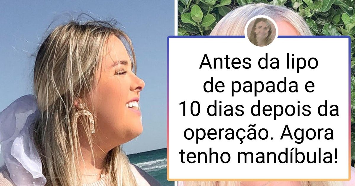 17 Pessoas que decidiram fazer uma cirurgia plástica para esquecer de vez os complexos do passado 17 Pessoas que decidiram fazer uma cirurgia plástica para esquecer de vez os complexos do passado