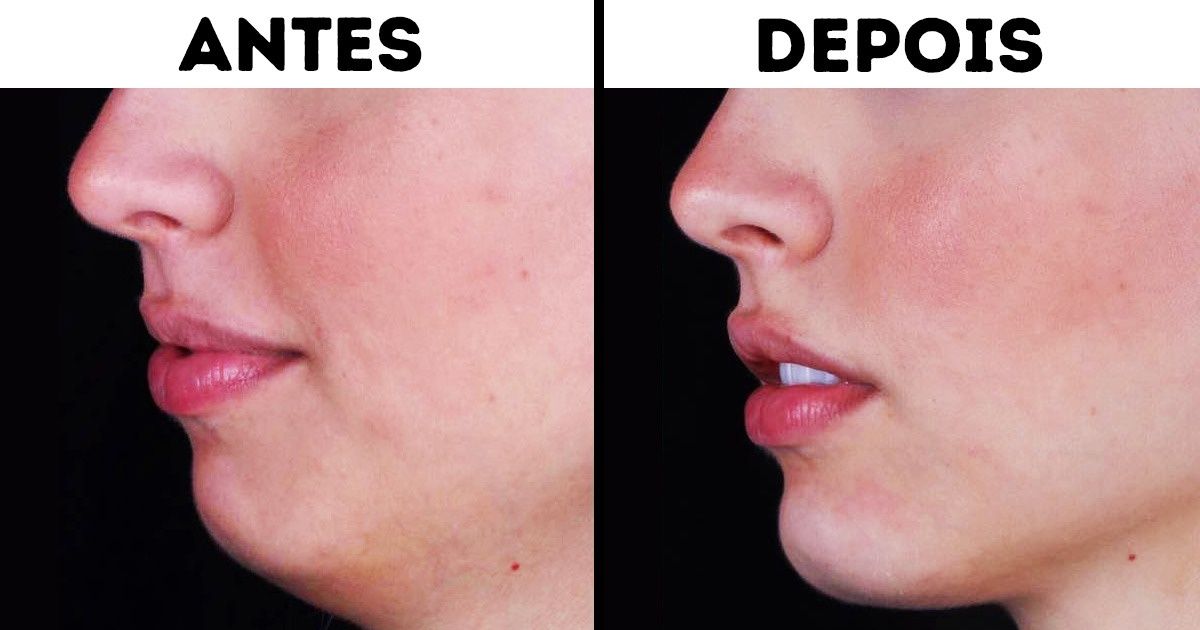 Por que a harmonização facial virou moda entre os brasileiros Por que a harmonização facial virou moda entre os brasileiros
