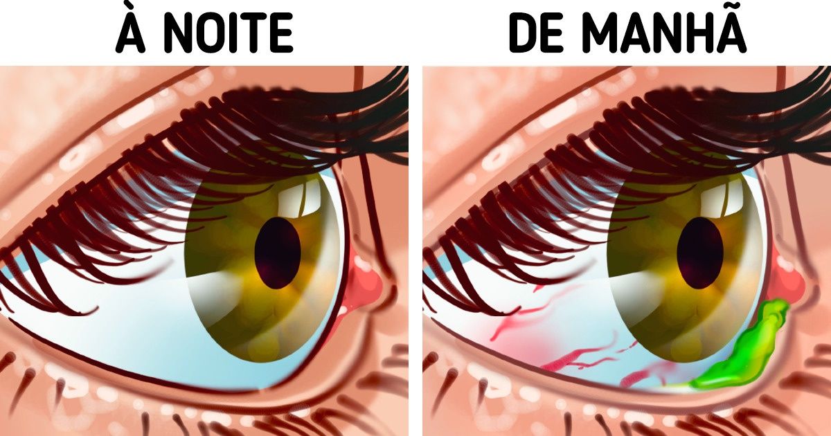 Por que os olhos acumulam secreção durante a noite