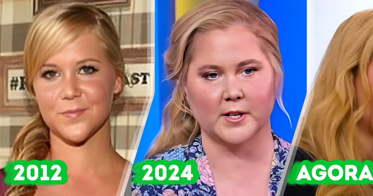 Amy Schumer revela que críticos na Internet a ajudaram a descobrir que tinha síndrome de Cushing Amy Schumer revela que críticos na Internet a ajudaram a descobrir que tinha síndrome de Cushing