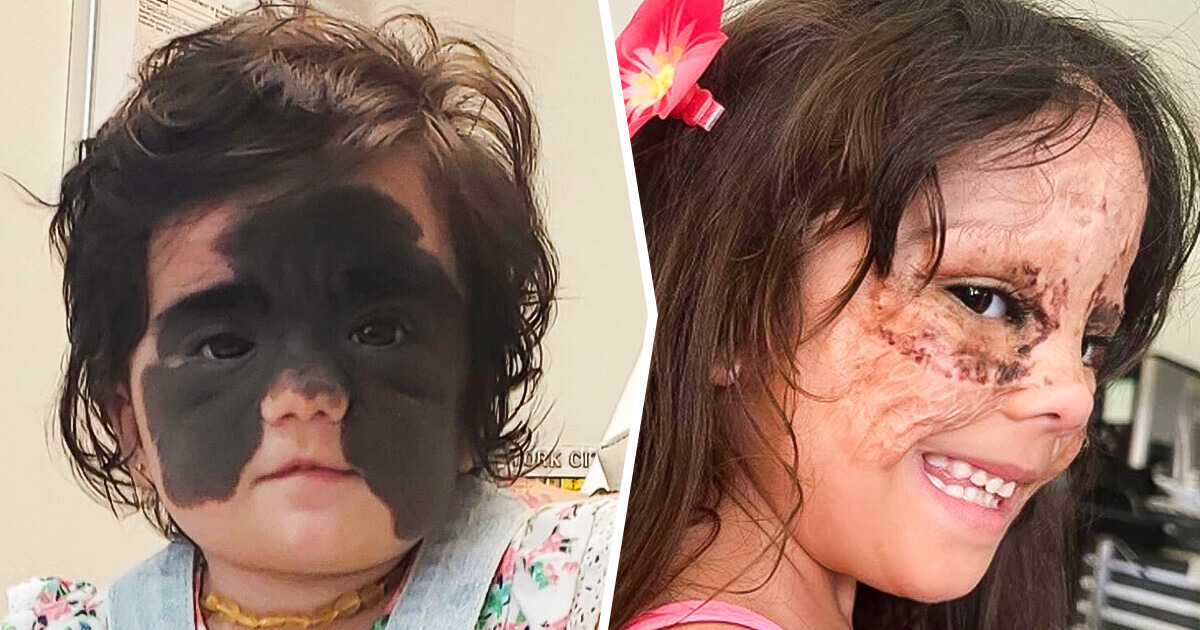 Luna supera sua marca de nascença e sorri para a vida, graças ao amor de sua mãe Luna supera sua marca de nascença e sorri para a vida, graças ao amor de sua mãe