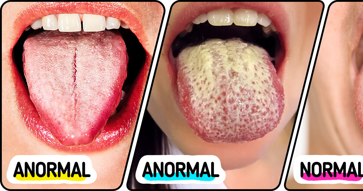8 Maneiras eficazes para ter uma língua saudável e rosada