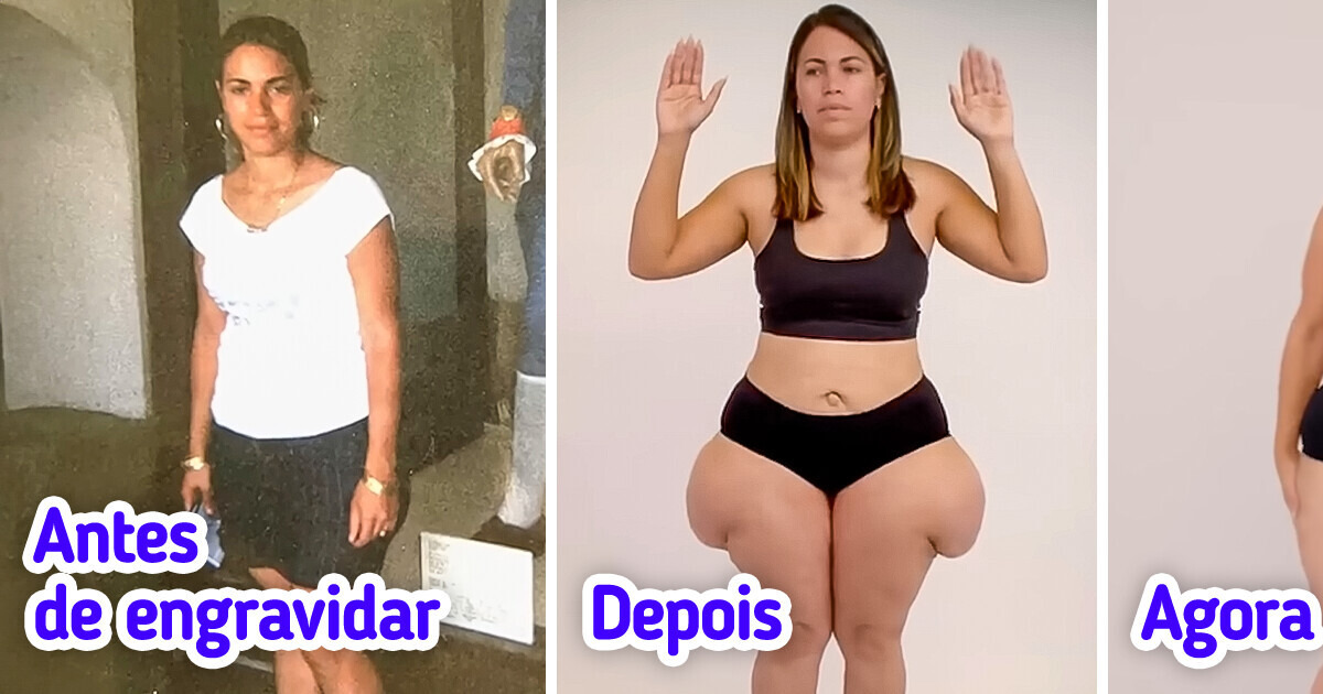 Após seu quadril triplicar de tamanho na gravidez, ela chorou de emoção ao ver o resultado da cirurgia Após seu quadril triplicar de tamanho na gravidez, ela chorou de emoção ao ver o resultado da cirurgia