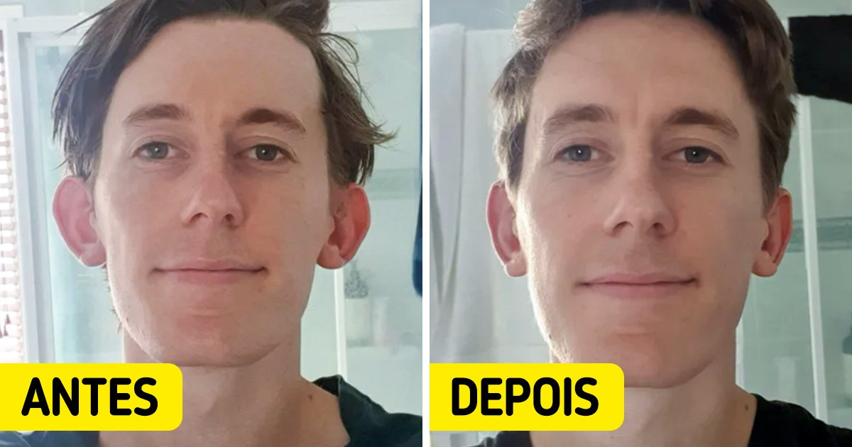 14 Pessoas que decidiram fazer cirurgias plásticas e ficaram gratas pelos procedimentos