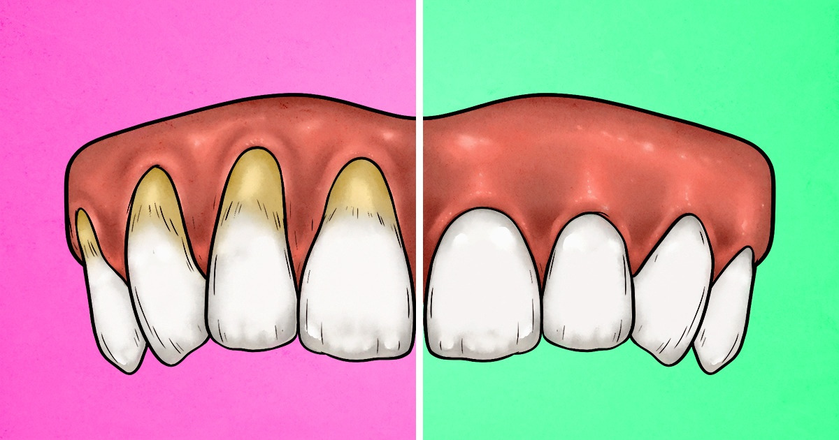 4 Sinais de que você está escovando os dentes com muita força e 4 maneiras de melhorar isso 4 Sinais de que você está escovando os dentes com muita força e 4 maneiras de melhorar isso