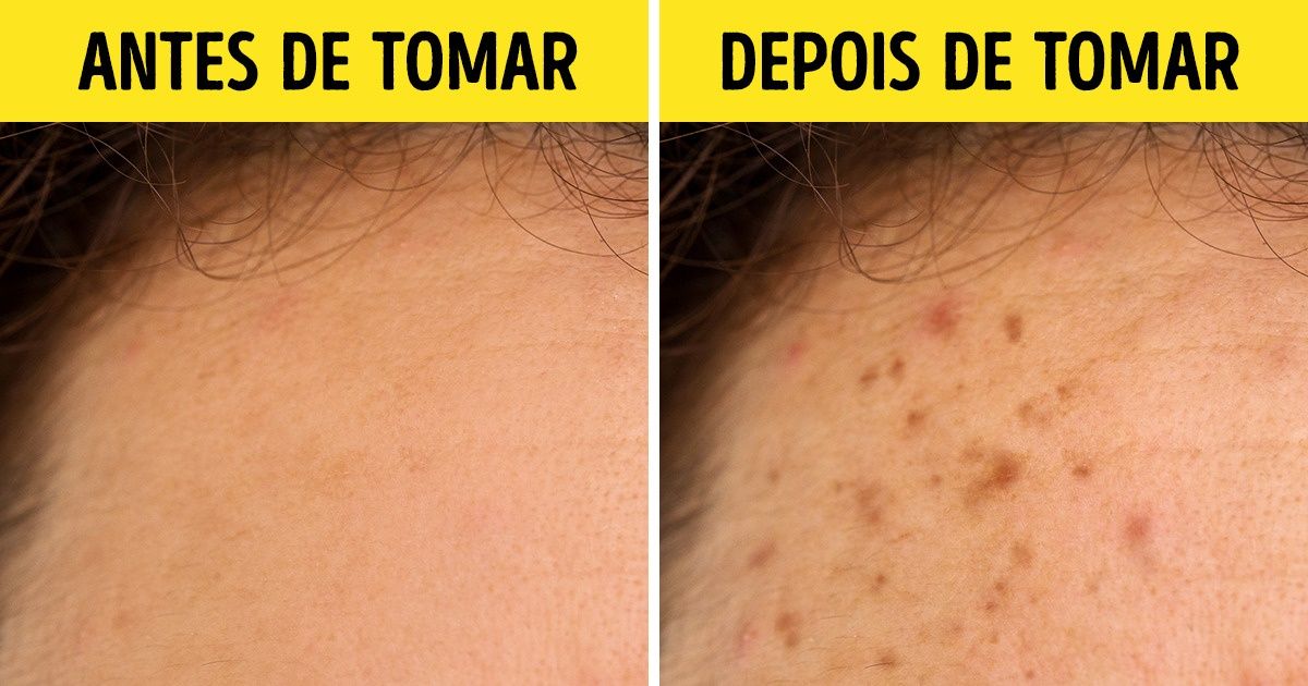 Medicamentos que não se deve consumir se for se expor ao sol Medicamentos que não se deve consumir se for se expor ao sol