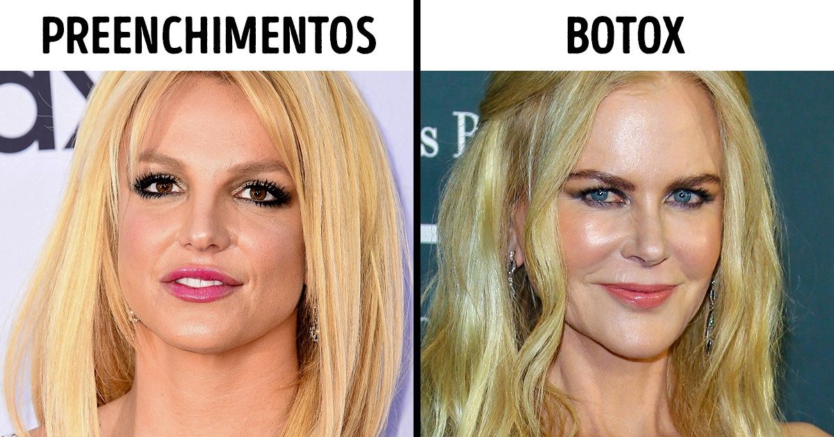 18 Famosas que fizeram cirurgia plástica e contaram pra todo mundo 18 Famosas que fizeram cirurgia plástica e contaram pra todo mundo