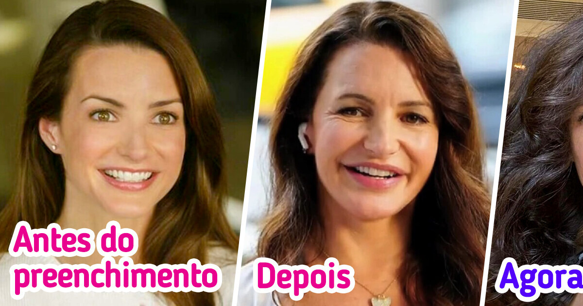10 Famosas que reverteram procedimentos estéticos e abraçaram sua beleza natural