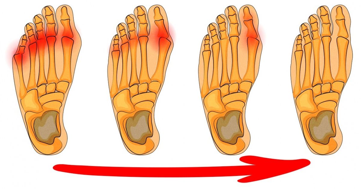 4 maneiras eficientes para se livrar dos joanetes