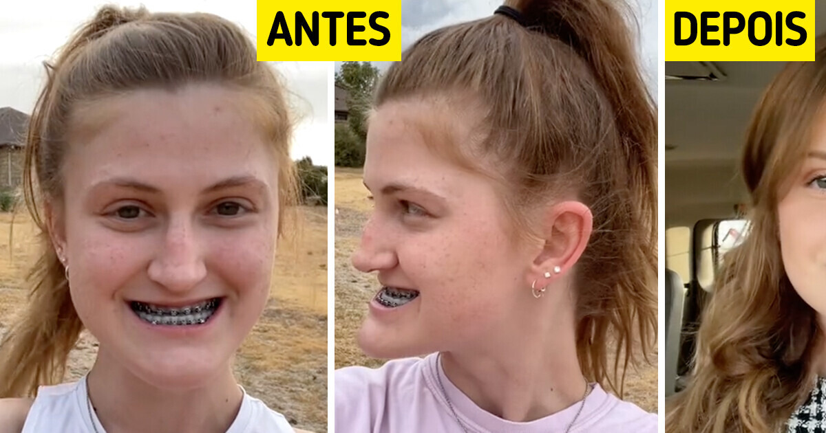 Jovem documenta cirurgia na mandíbula e surpreende o mundo com seu novo visual Jovem documenta cirurgia na mandíbula e surpreende o mundo com seu novo visual