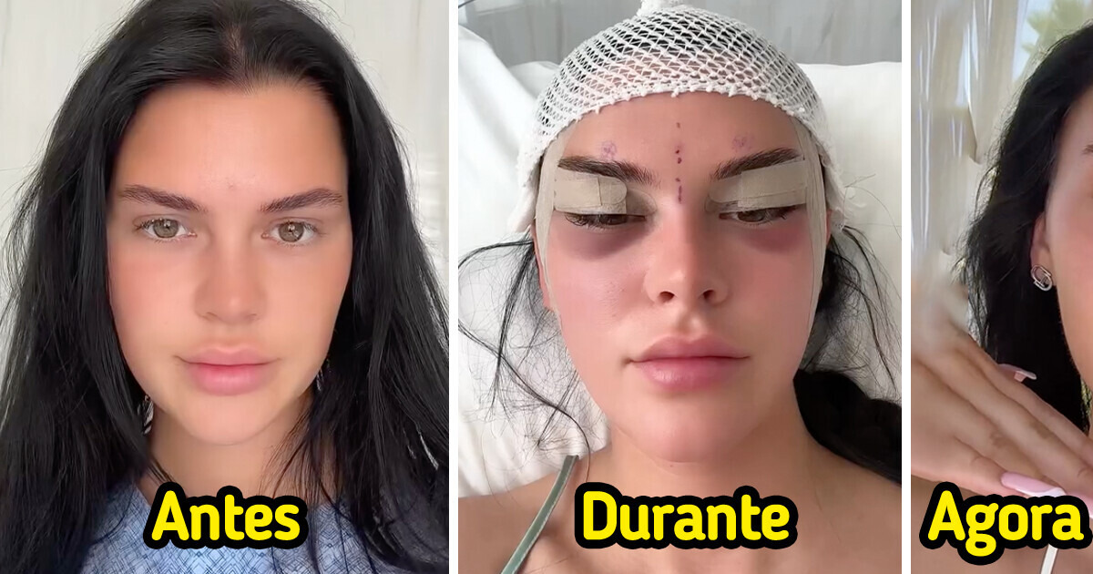 Jovem documenta sua cirurgia “olhos de raposa” e choca as pessoas com os resultados Jovem documenta sua cirurgia “olhos de raposa” e choca as pessoas com os resultados