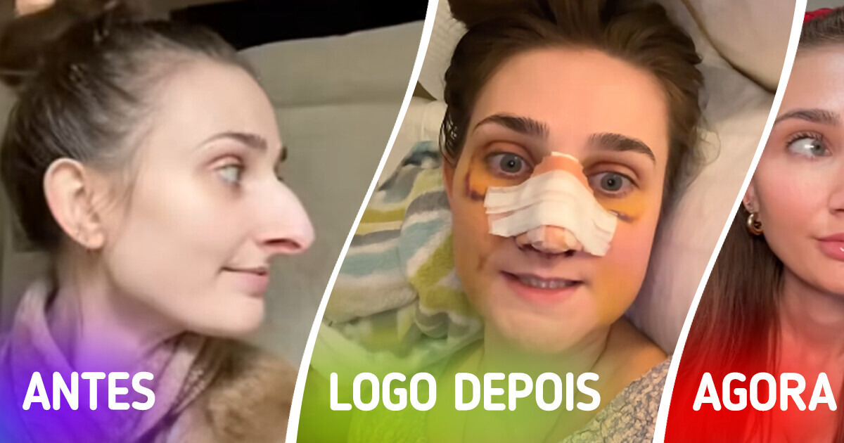 Jovem revela antes e depois de sua rinoplastia e impressiona com a mudança Jovem revela antes e depois de sua rinoplastia e impressiona com a mudança