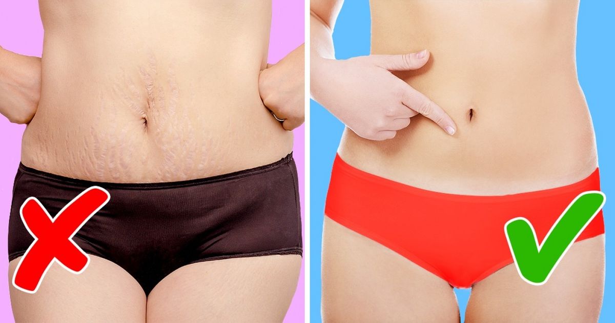 8 Dicas para reduzir estrias 8 Dicas para reduzir estrias